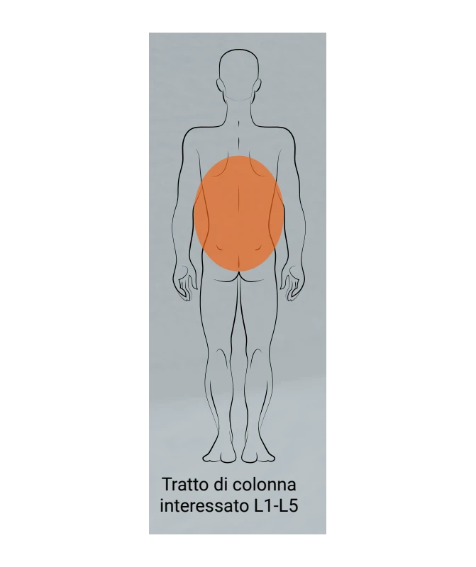 RO+TEN - Lumbofast Pad - Pelote Aggiuntive Per Lumbofast 2 RO+TEN - Lumbofast Pad - Pelote Aggiuntive Per Lumbofast - immagine 2